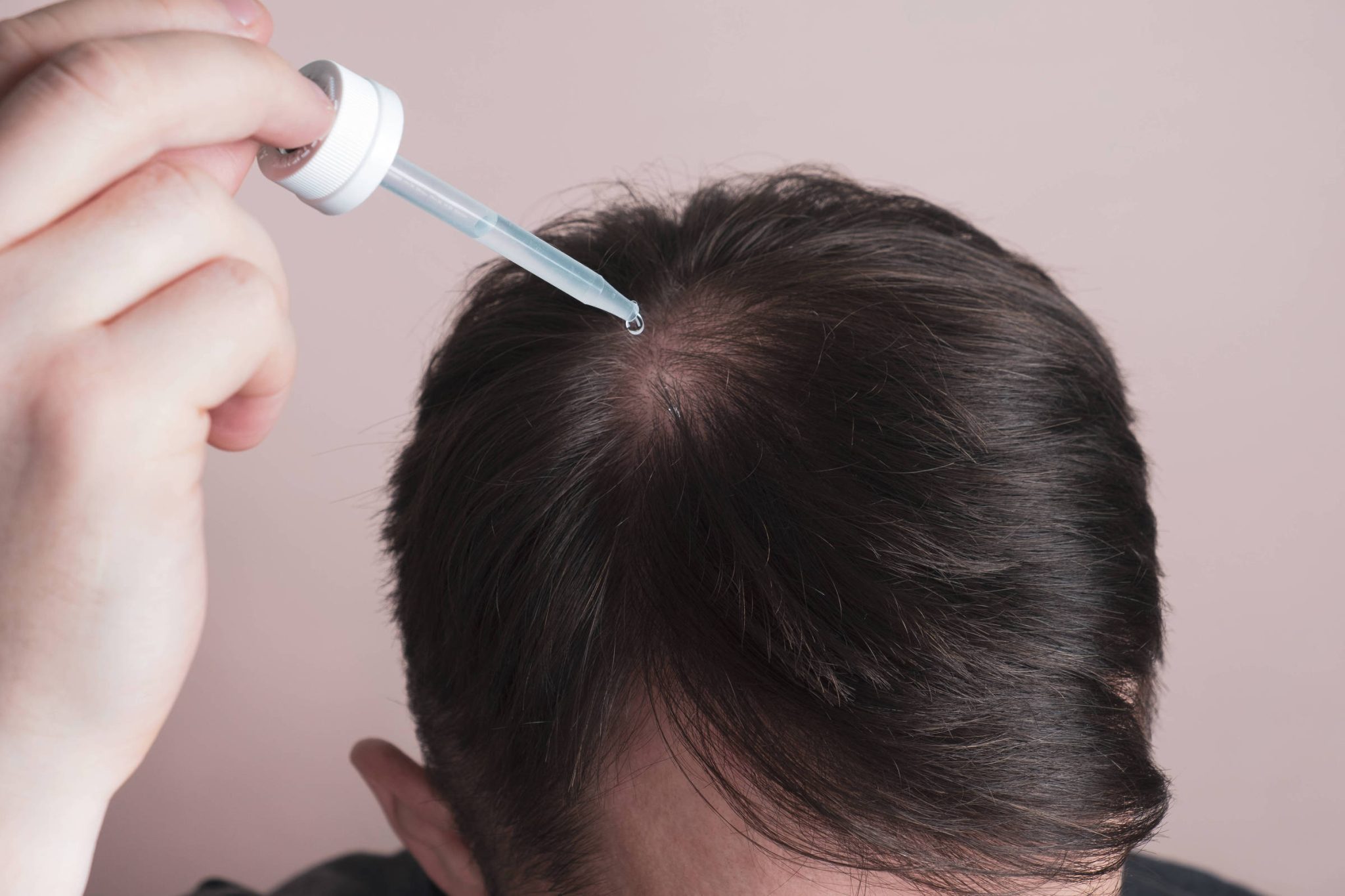 minoxidil-pode-causar-crescimento-anormal-de-pelos-em-bebes,-alerta-anvisa